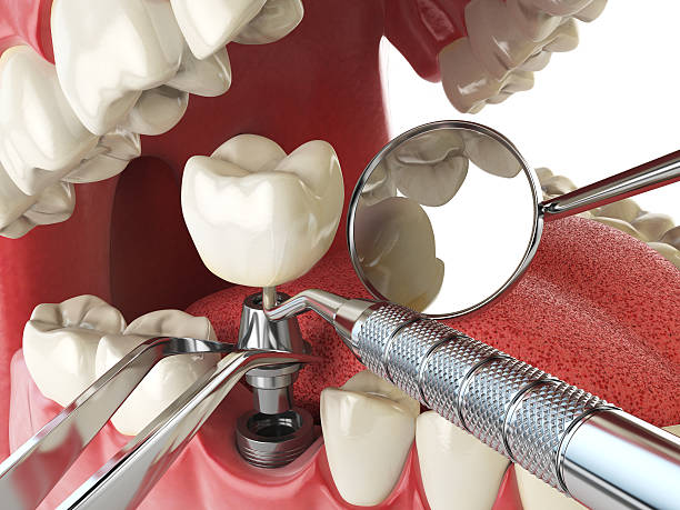 Best Emergency Dentist for Lost Fillings or Crowns in Deville, AL